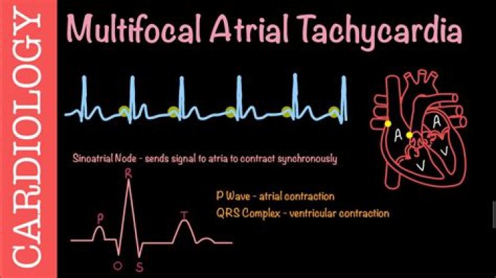 What is the rate of atrial tachycardia