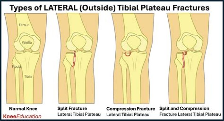 What is the treatment for a tibial plateau fracture