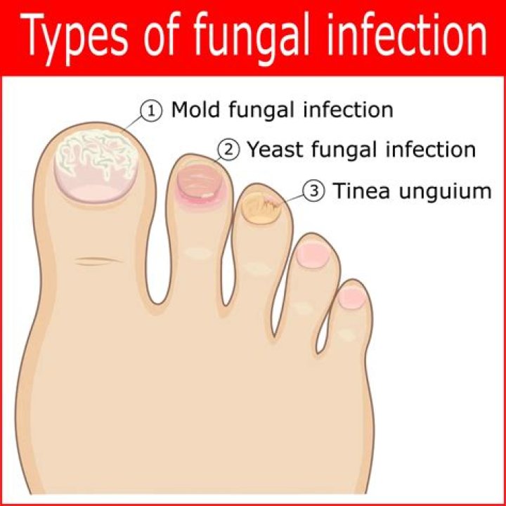 What is tinea Unguium mean