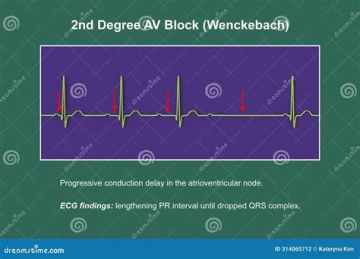 What is wenckebach syndrome