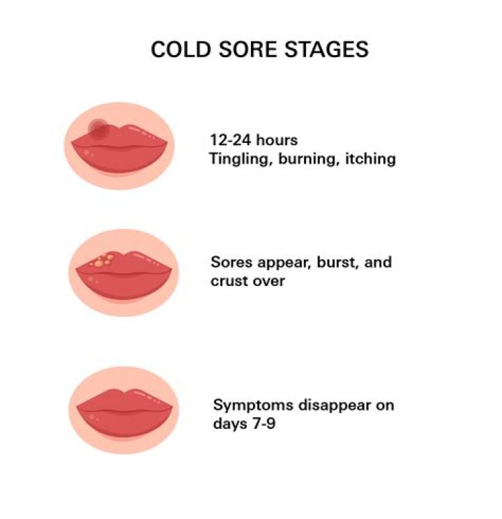Why do I get cold sores