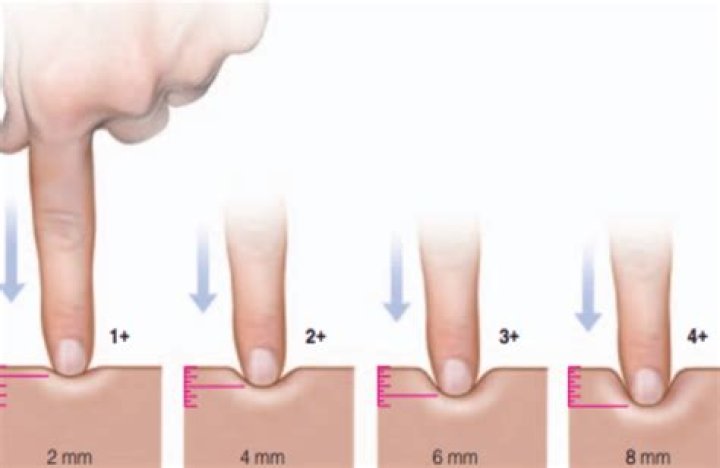 Why do I have pitting edema in my shins